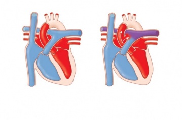 Serce, wrodzone wady serca i metody ich leczenia